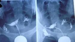 输卵管造影多少钱？东吴费用低 怀孕快