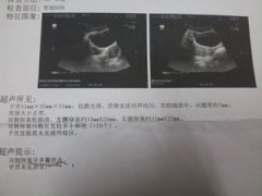 全面分析多囊卵巢综合症
